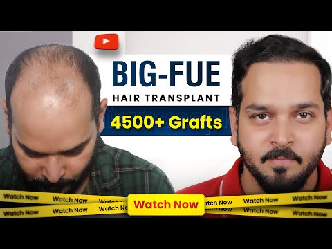 Hair Transplant in Surat | Amazing Hair Transplant Results & Best Hair Transplant Doctor in Surat