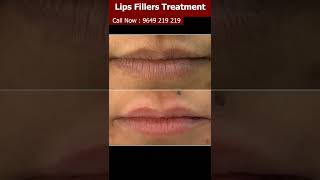 At Last, The Secret To LIPS FILLERS TREATMENT Is Revealed | Viral #shorts