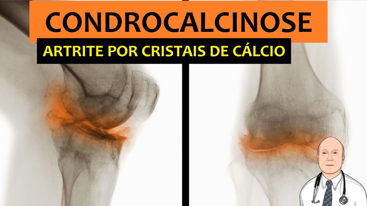 O que você precisa saber sobre condrocalcinose, reumatismo por cristais de cálcio.