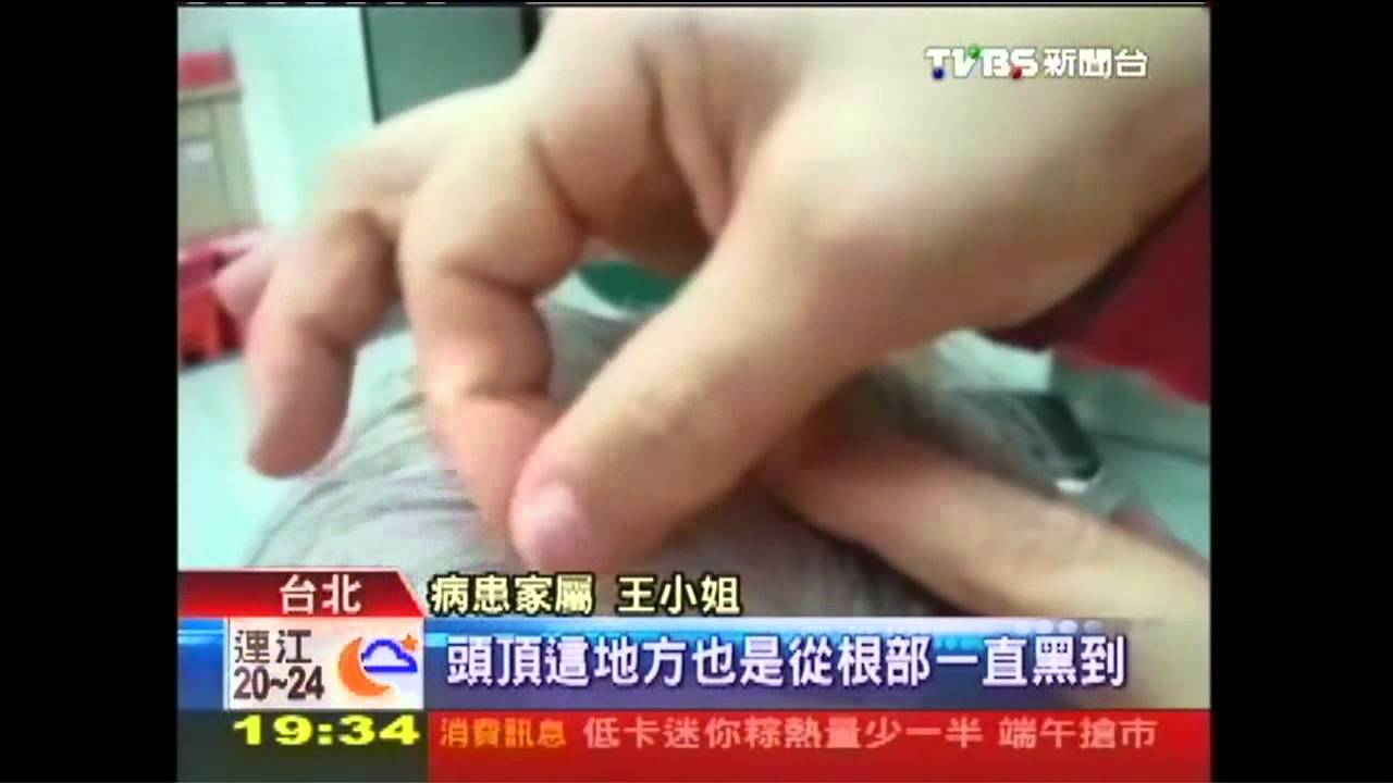 8旬中風婦針灸復健　意外回春長黑髮