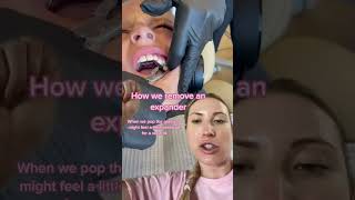 How to remove an expander #shorts #expander #orthodontics