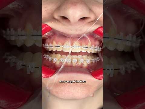 Are you Flossing Properly with Braces? Probably NOT....