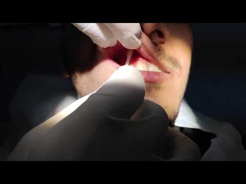 Maxillary Infiltration Anesthesia Technique