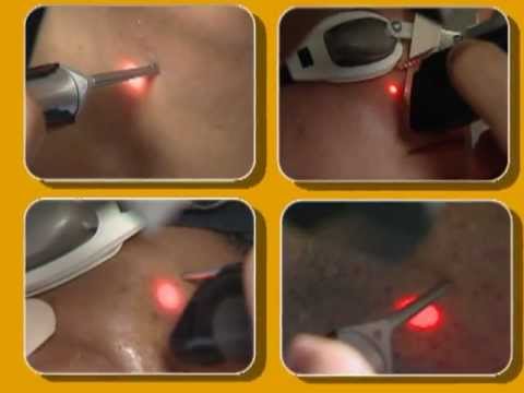 Laser Hair Removal video by Cynosure