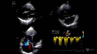 Pulmonary hypertension in adult congenital heart disease – Dr David Tanous