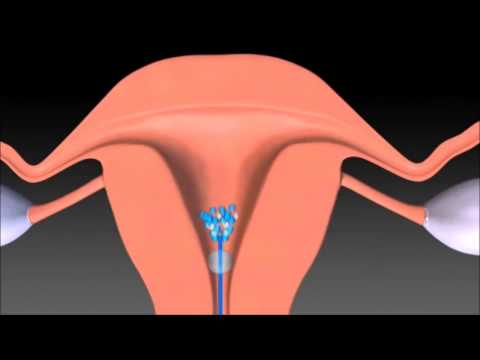 Adenoma prostatico può utilizzare la sauna Esercizi con gli uomini prostatite