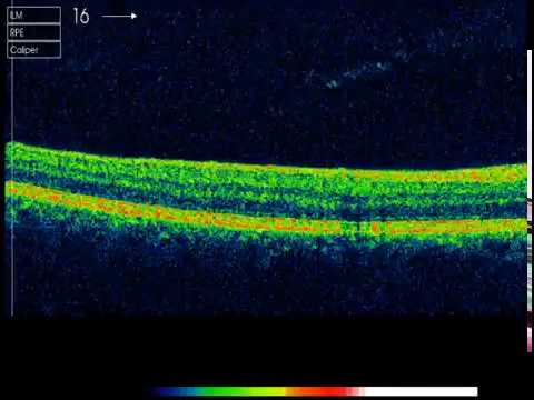 Barrido de OCT (macular cube) en fóvea de mácula sana