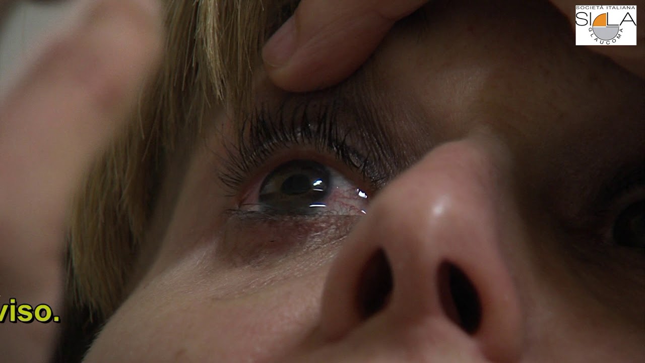 Watch Now Come fare un'applicazione corretta dei colliri oftalmici Come fare un'applicazione corretta dei colliri oftalmici