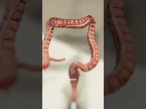 How Is Colon Hydrotherapy Performed( (3D Animation) #colonhydrotherapy#doctor