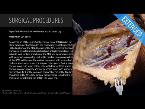 Superficial Peroneal Nerve Release in the Lower Leg - Extended (Feat. Dr. Mackinnon)