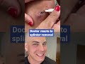 Doctor reacts to splinter removal!