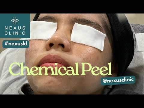 Chemical Peel Treatment by Nexus Clinic KL