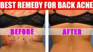 How to Get Rid of Back Acne in a Week