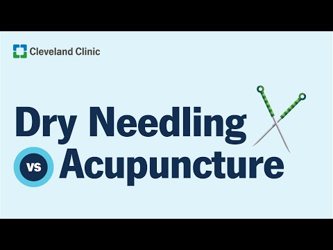 乾針 vs. 針灸：差別在哪裡？ (Dry Needling vs. Acupuncture: What’s the Difference?)