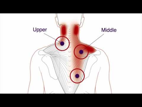 Trigger Point Therapy - Trapezius