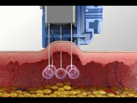 Ay posible na mawalan ng timbang sa tulong ng simulator Na maaaring slimming paggagatas