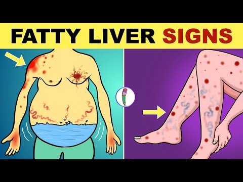 , title : 'Fatty Liver Symptoms | Early Signs of Fatty Liver Disease | Non Alcoholic Fatty Liver Disease'