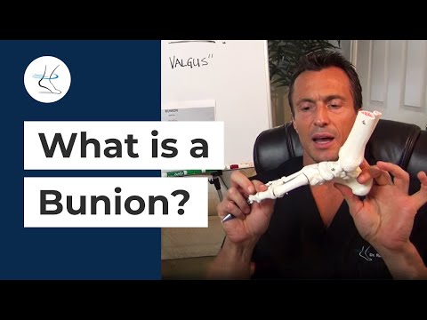 What is a bunion?
