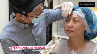 Non-Surgical Eyebag Removal at Cambridge Medical