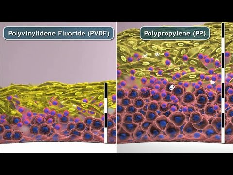 Fremdkörperreaktion PVDF vs. PP