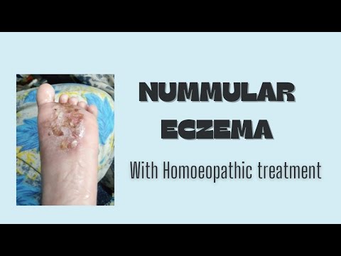 Nummular eczema