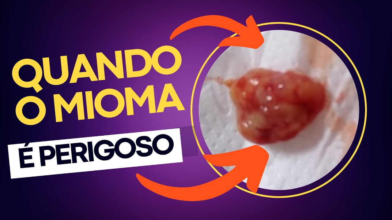 MIOMA NO ÚTERO: QUANDO SE PREOCUPAR? Live especial Dr. Michel Palheta