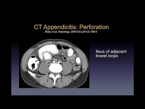 Imaging of appendicitis