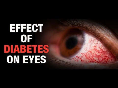 Die Wahrscheinlichkeit von Diabetes ist geerbt Empfehlungen für Patienten mit Diabetes Massage