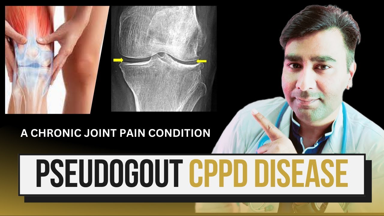 What is CPPD Arthritis Disease: Causes, Symptoms, and Treatment | Pseudogout Explained