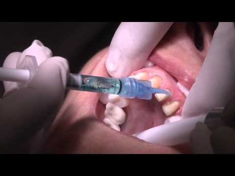 Veneer Replacement Procedure