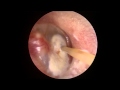 Endoscopic Ear (Ventilation) Tube Placement