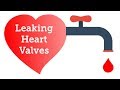 Cardiologist Q&A: Do Leaking Heart Valves Require Surgery?