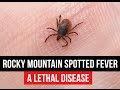Rocky Mountain Spotted Fever (RMSF)