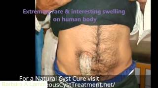 Sebaceous Cyst HORN!.. Wtf!!! - Barbara A Lamm
