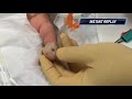 Finger Pulp Abscess Drainage EXPLOSION Of Pus Watch To The End For Patient POEM