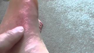 preview picture of video 'Discover How to Immediate Fix Pain and Swelling from Insect Bite, Hamilton, New Zealand'