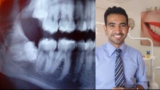 ¿Las muelas del juicio mueven  los dientes