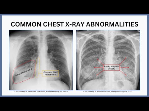 Common Chest X Ray Abnormalities