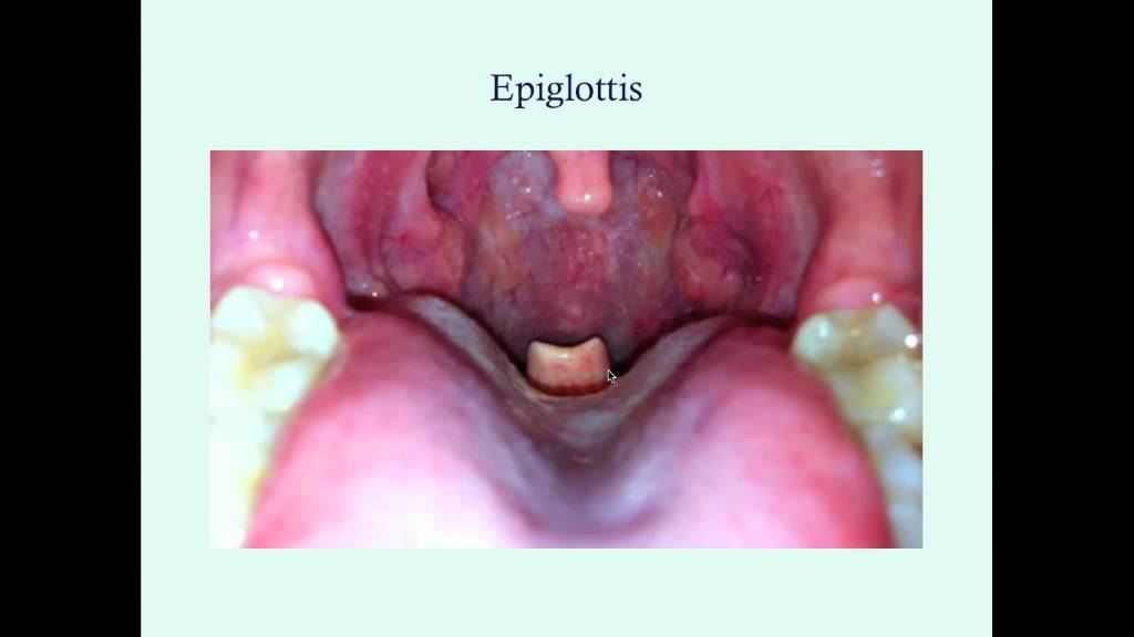 Epiglottitis - CRASH! Medical Review Series - YouTube