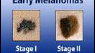 Melanoma - Treatment