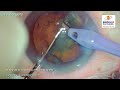 Live surgery trench divide and bevel down from Nandadeep Eye Hospital
