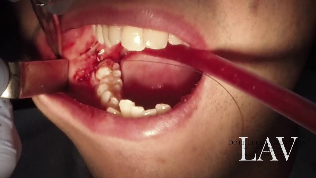 Watch Now Estrazione chirurgica di dente del giudizio - Dott. Vaira Chirurgo Maxillo-Facciale Sassari Estrazione chirurgica di dente del giudizio - Dott. Vaira Chirurgo Maxillo-Facciale Sassari