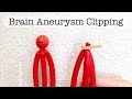 Playdough Surgery Brain Aneurysm Clipping