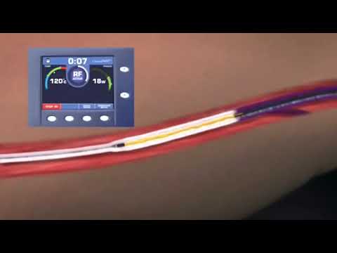 Varicose Veins Methods of Treatment