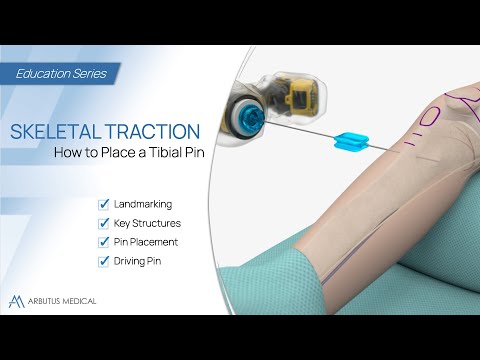 How to Place a Tibial Pin - Skeletal Traction Animation