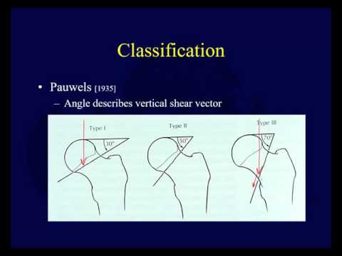 Proximal Femur Fractures   Femoral Neck Fractures 1