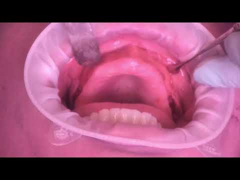 Chrome™ Full Arch Guided Smile