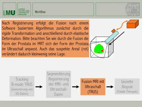 Leukozyten in der Analyse von Prostatasekret Prostata-Adenom Osteochondrose