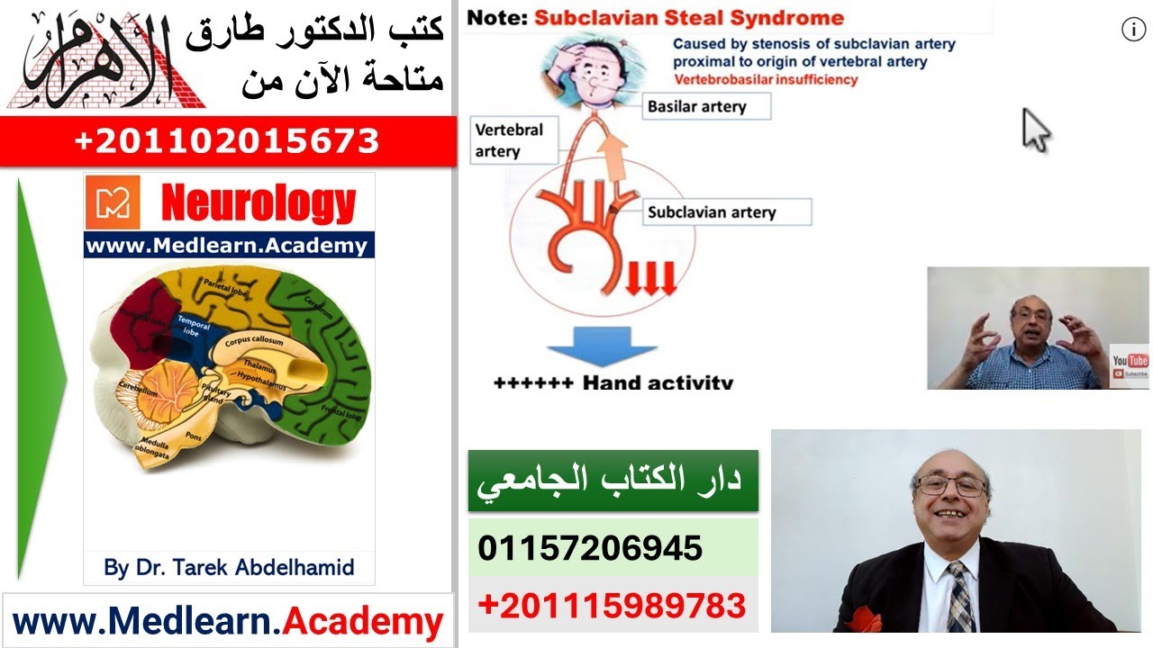 Transient Ischemic Attacks TIA  (4) #internal_medicine #cme #medicaleducation #محاضرات_باطنة