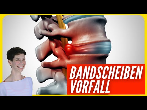 Akuter Bandscheibenvorfall: Diese Positionen helfen| #HannahGantner​